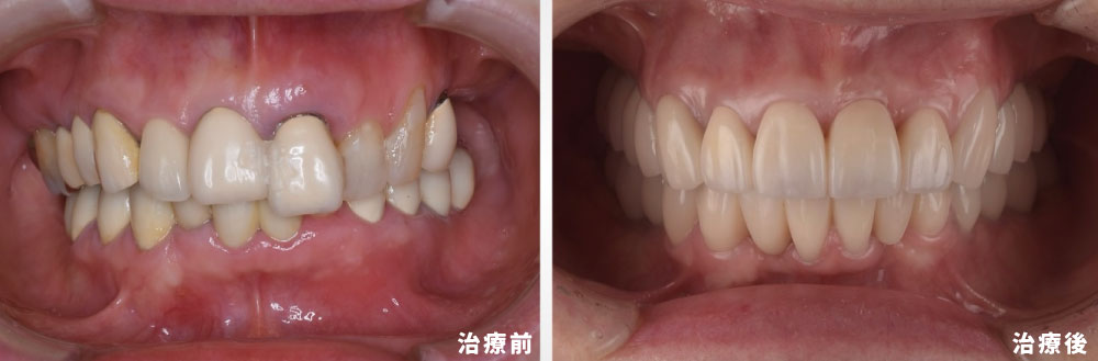自然に見える歯で笑顔に。精密な歯科治療
