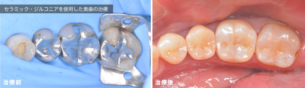歯を健康に長く使うために。セラミックを使用した精密歯科治療